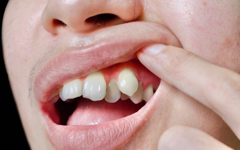 哨牙：口腔健康的重要問題